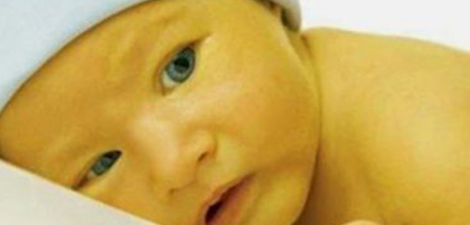 زردی نوزاد یایرقان؛ علل، نشانه‌ها و روش‌های درمان