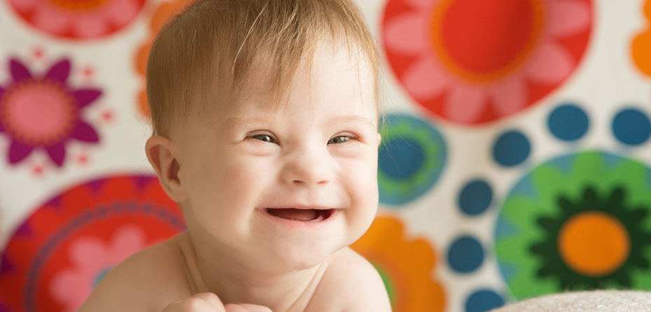شیردهی به کودک مبتلا به سندرم داون چگونه است؟