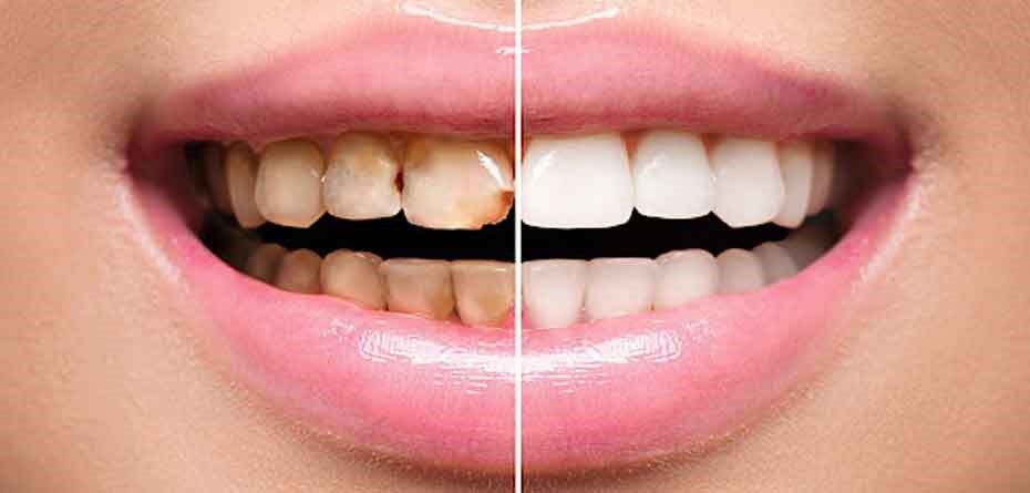 پاسخ متخصصان به رایجترین سوالات درباره لمینت دندان 