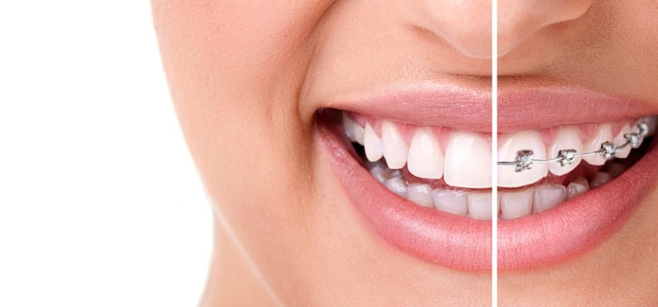 ارتودنسی دندان چیست ( هزینه ، انواع و مراقبت ) 