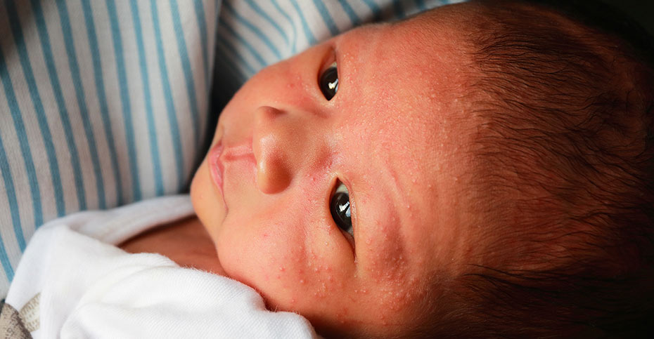 همه چیز درباره لکه‌های شیر ایجاد شده روی پوست نوزاد