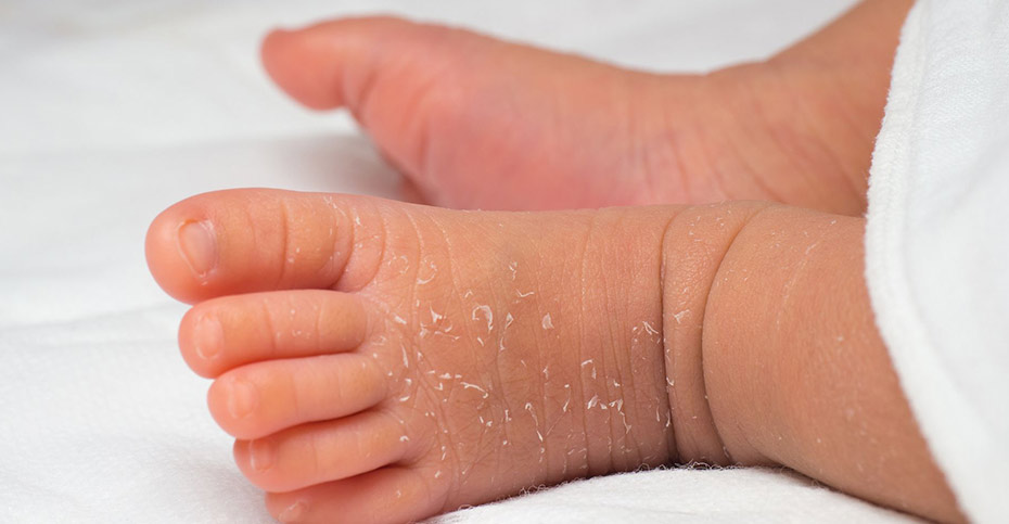 لایه‌برداری پوست در نوزادان