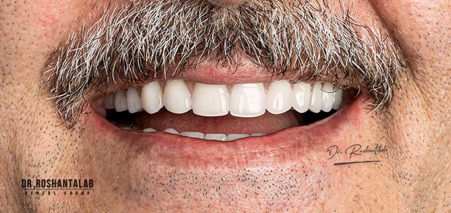  ایمپلنت دندان چیست؟ 