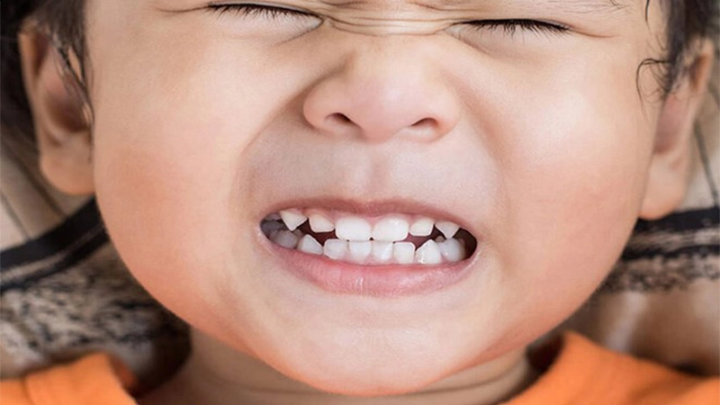 دندان قروچه در کودکان علل و درمان