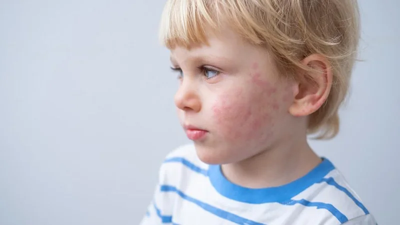 علت آلرژی فصلی پوستی در کودکان
